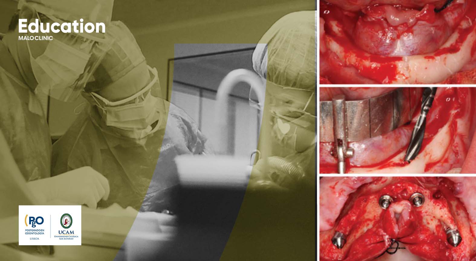 All-on-4® Surgical Protocol Clinical Course | March Edition