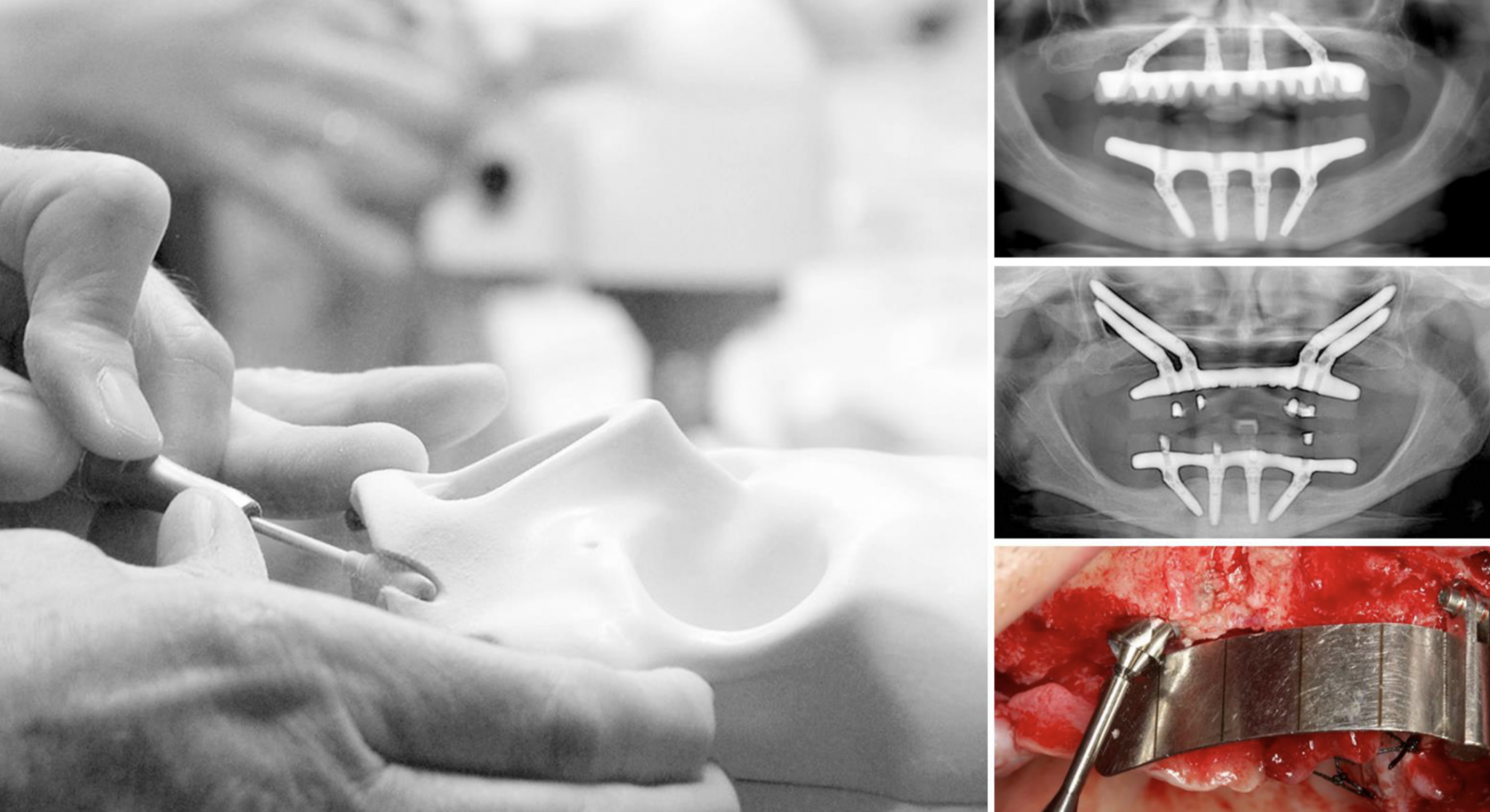 Cadaver Course Allon4® Surgical Protocol From Standard to Zygoma