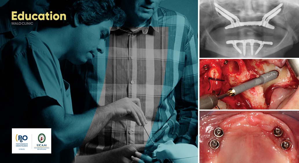 All-on-4® Surgical Protocol – High Skilled & Zygoma Maxilla Rehabilitation | April Edition