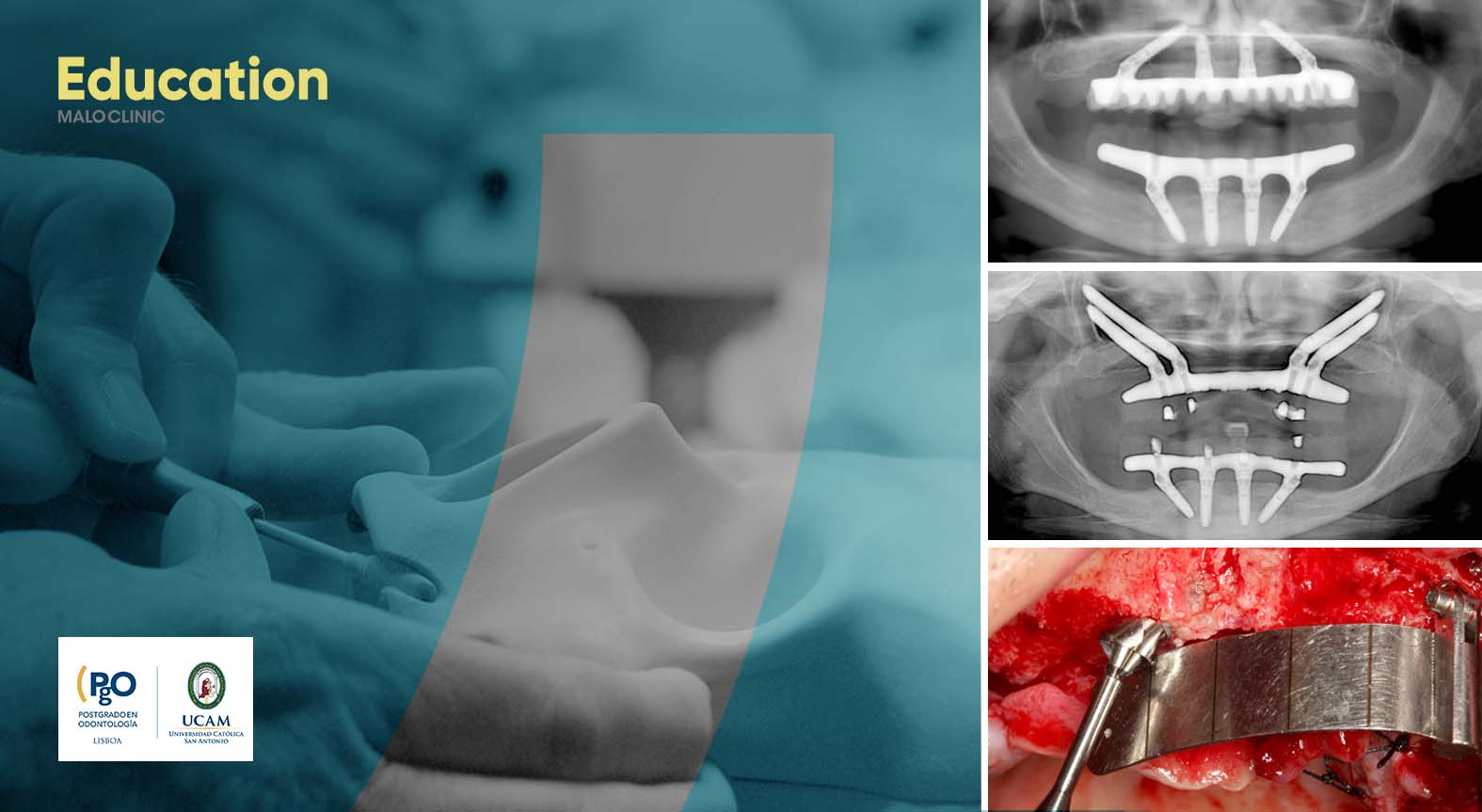 Cadaver Course | All-on-4® Surgical Protocol – From Standard to Zygoma Cases