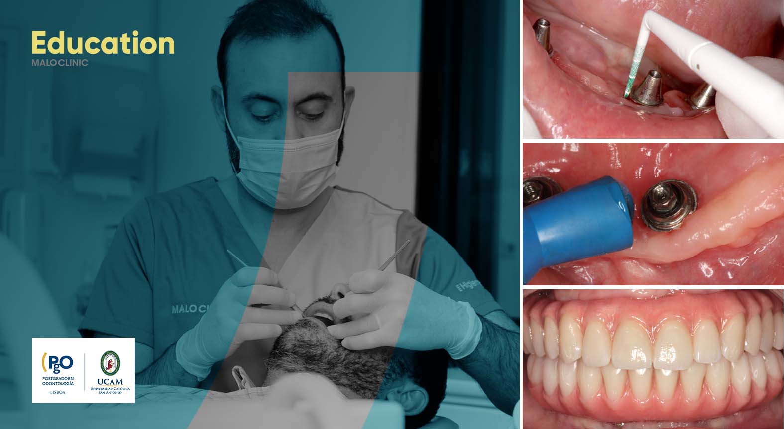 Implant Maintenance – A Practical Approach | September Edition