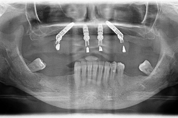 All-on-4® MALO CLINIC