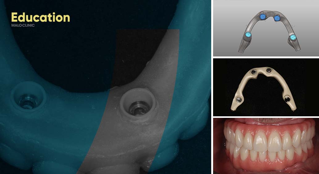 ALL-ON-4® Concept Using PEEK Polymer as Prosthetic Infrastructure | September Edition