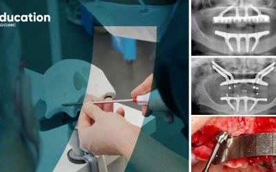 Cadaver Course | All-on-4® Surgical Protocol – From Standard to Zygoma Cases: November Edition