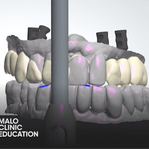 Malo Clinic Pro Arch: The Digital Full Arch Experience